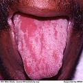 Click image for larger version

Name:	erythematous candidiasis.jpg
Views:	135
Size:	18.5 KB
ID:	64168