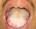 Click image for larger version

Name:	pseudomembranous candidiasis.jpg
Views:	125
Size:	9.2 KB
ID:	64169