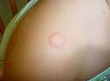 Click image for larger version

Name:	ringworm.jpg
Views:	729
Size:	26.1 KB
ID:	64632